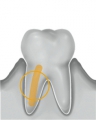 Inserts CCS d'irrigation Endodontie Acteon 160602