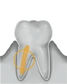 Inserts CCS d'irrigation Endodontie Acteon 160602