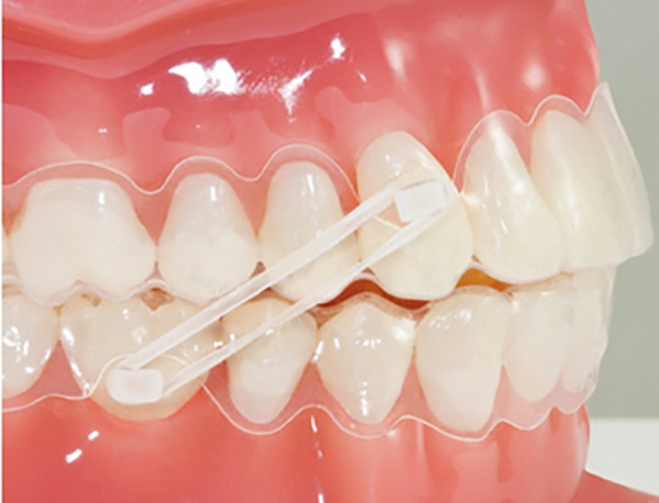 Boutons En Composite OrthoflexTM Ortho Technology Boutons En Composite OrthoflexTM Ortho Technology